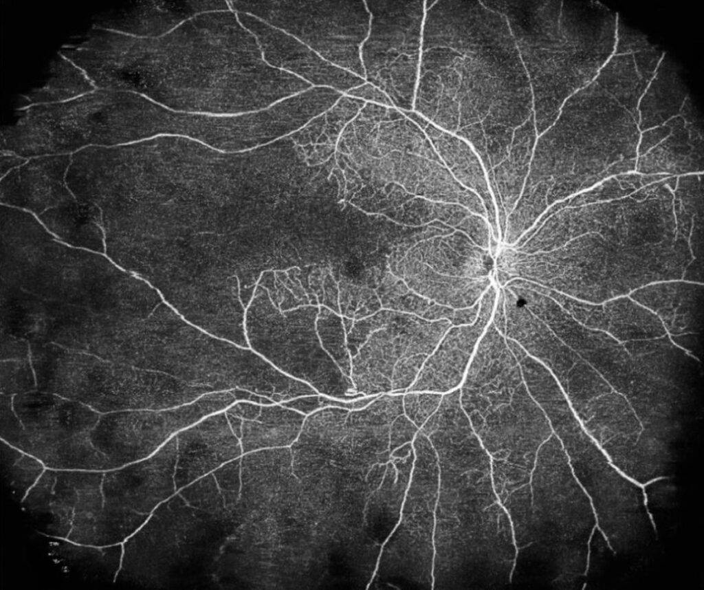 Abbildung 1: Diabetische Retinopathie: Widefield OCT Angiographie zeigt ischämische Areale in unserem OCT-Angigraphie Gerät.